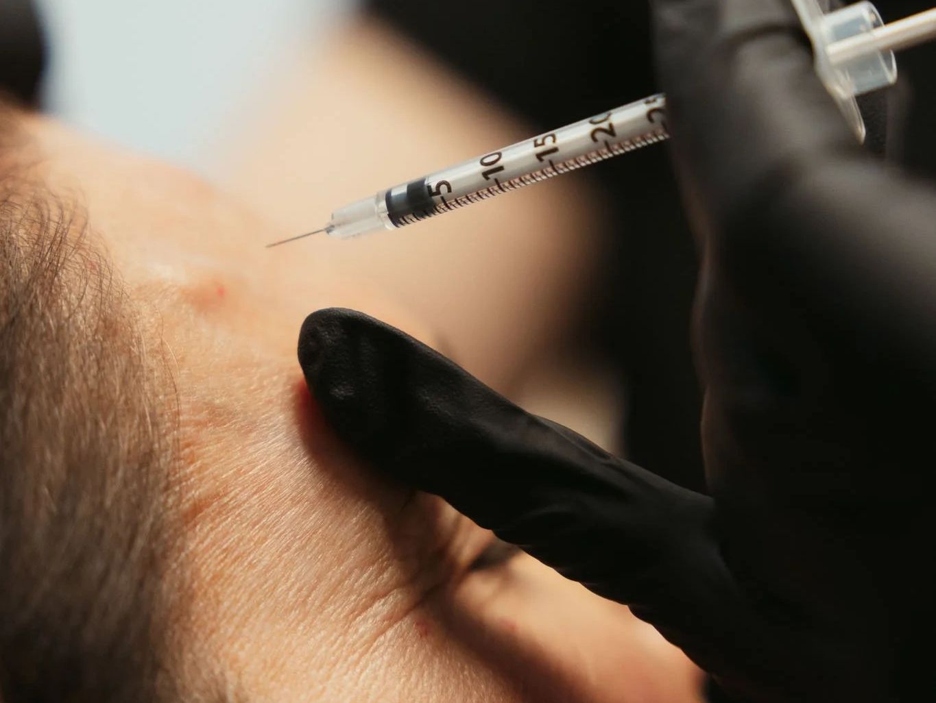 Close-up of a syringe injection on facial skin with black-gloved hand.
