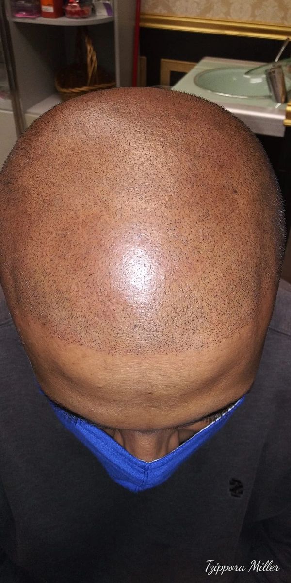Hair loss solutions Hair loss solutions