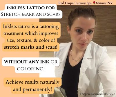 inkless tattoo to reduce stretch marks and scars