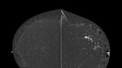 MRIs, contrast-enhanced mammography useful for small breast tumors