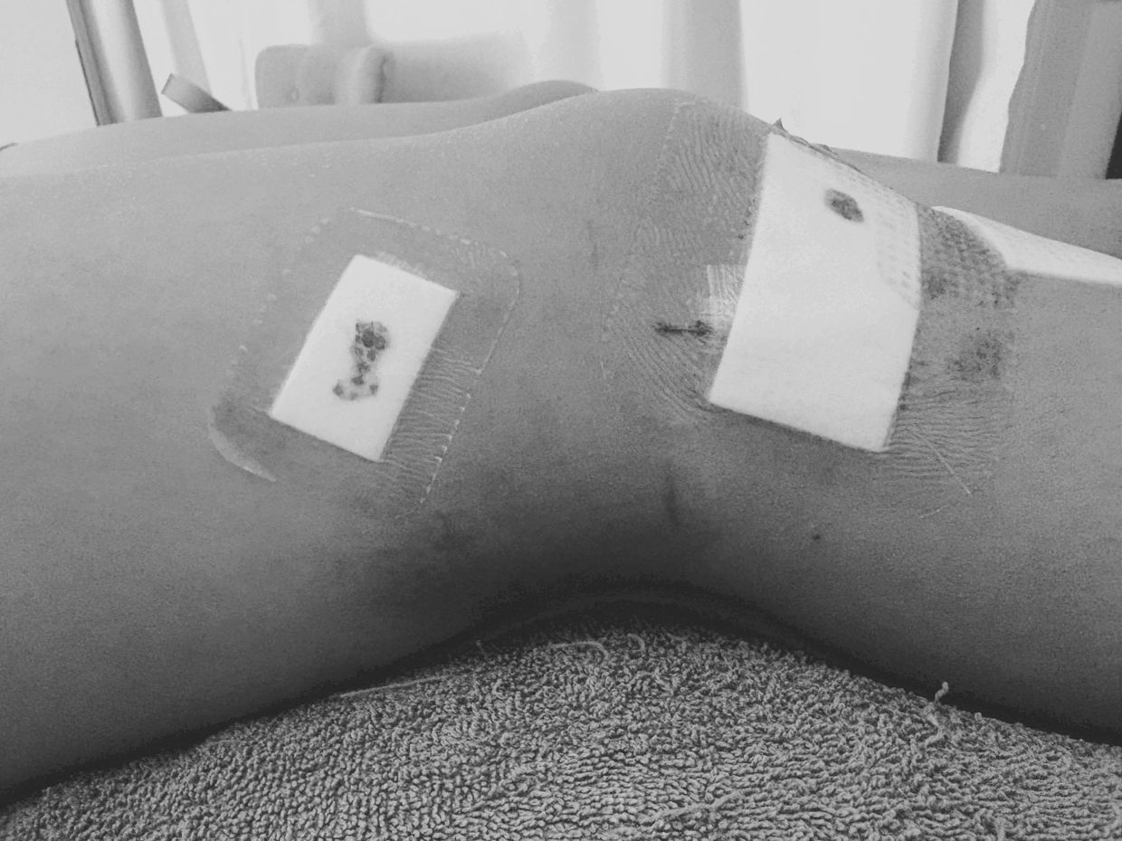 ACL Recovery
