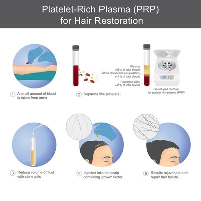 PRP for hair method