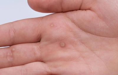 Warts are benign but many people are understandably bothered by their appearance. 
