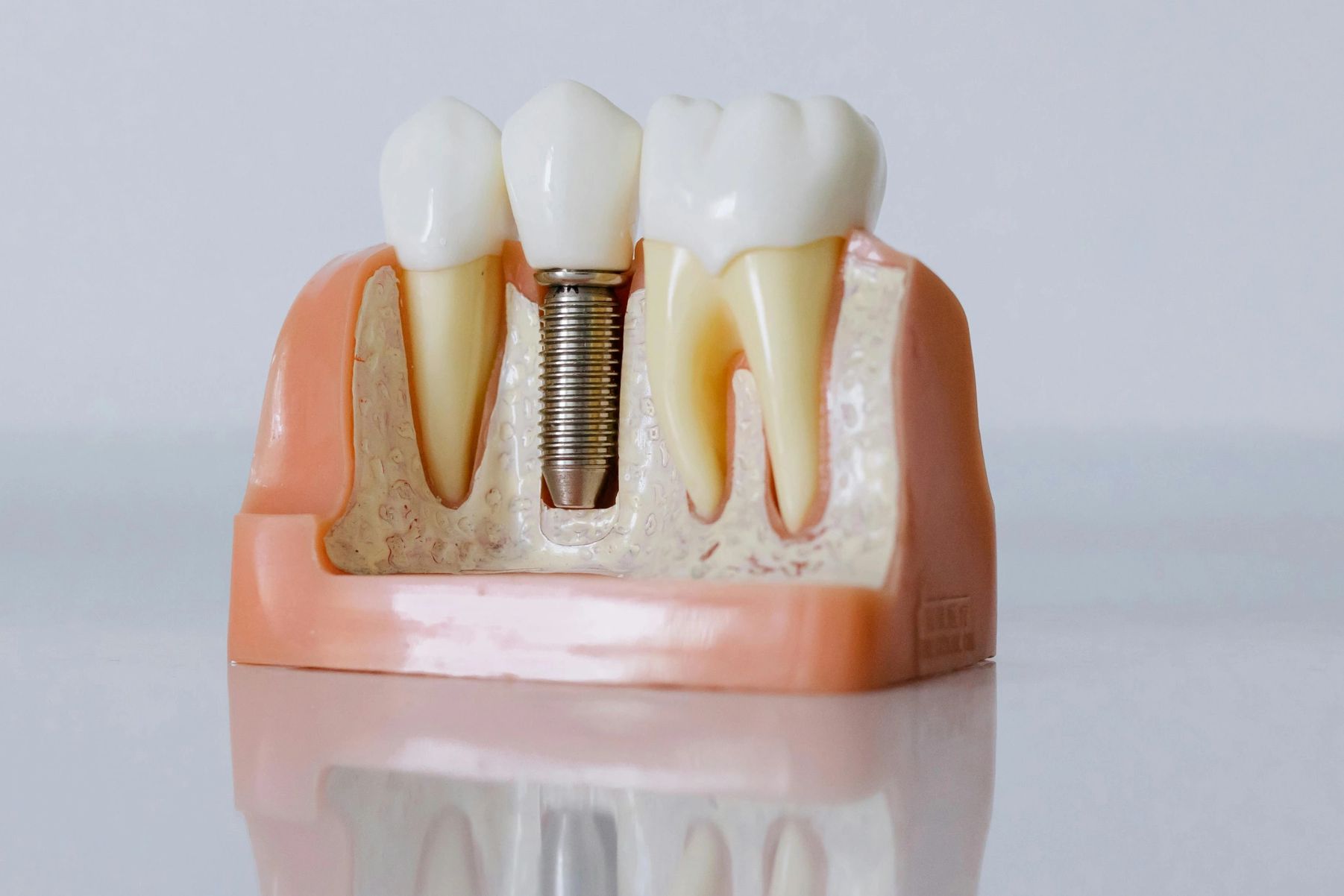 Model of dental implant alongside natural teeth showing gum and bone structure.