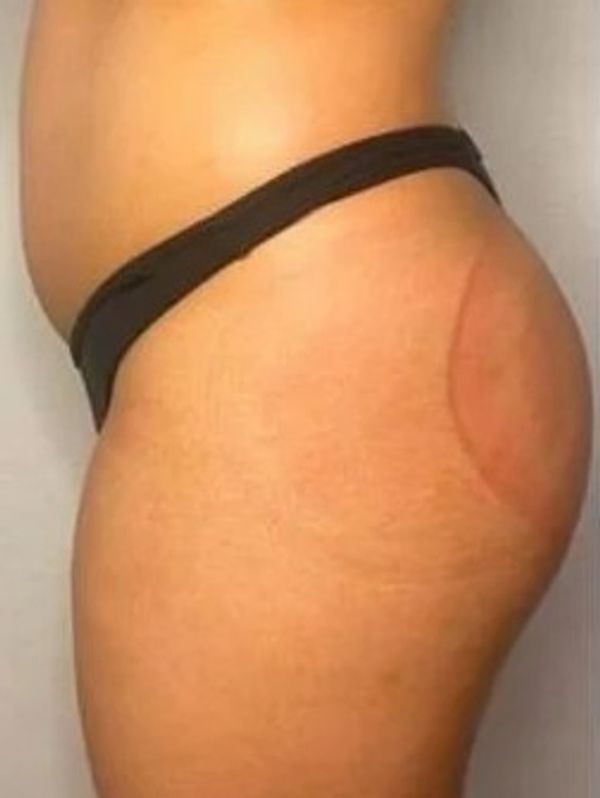 After- Vacuum Therapy Butt Lift result at GlowHaus Beauty. 