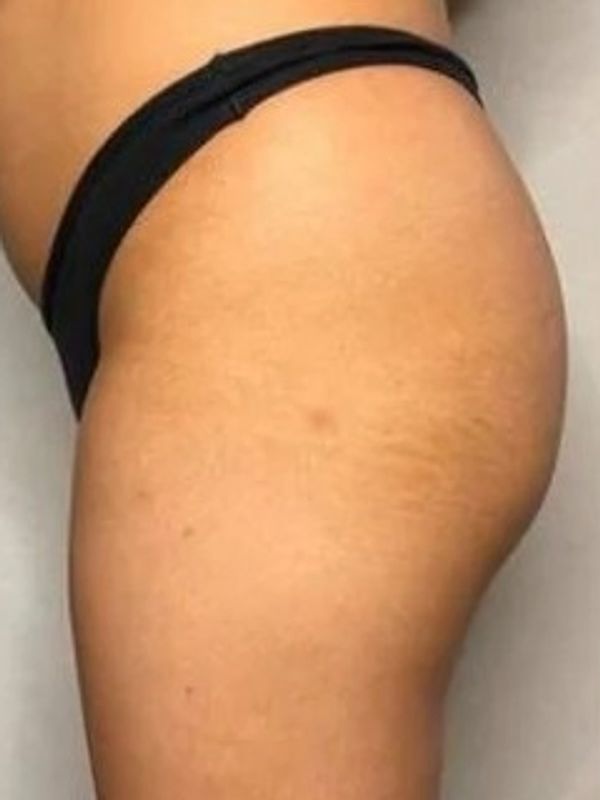 Before & After Results 