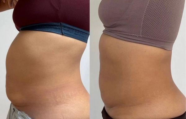 Before & after abdomen body sculpting result at GlowHaus Beauty in East Meadow, NY. Non-invasive bod