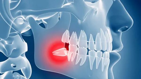 X-ray showing impacted wisdom tooth.