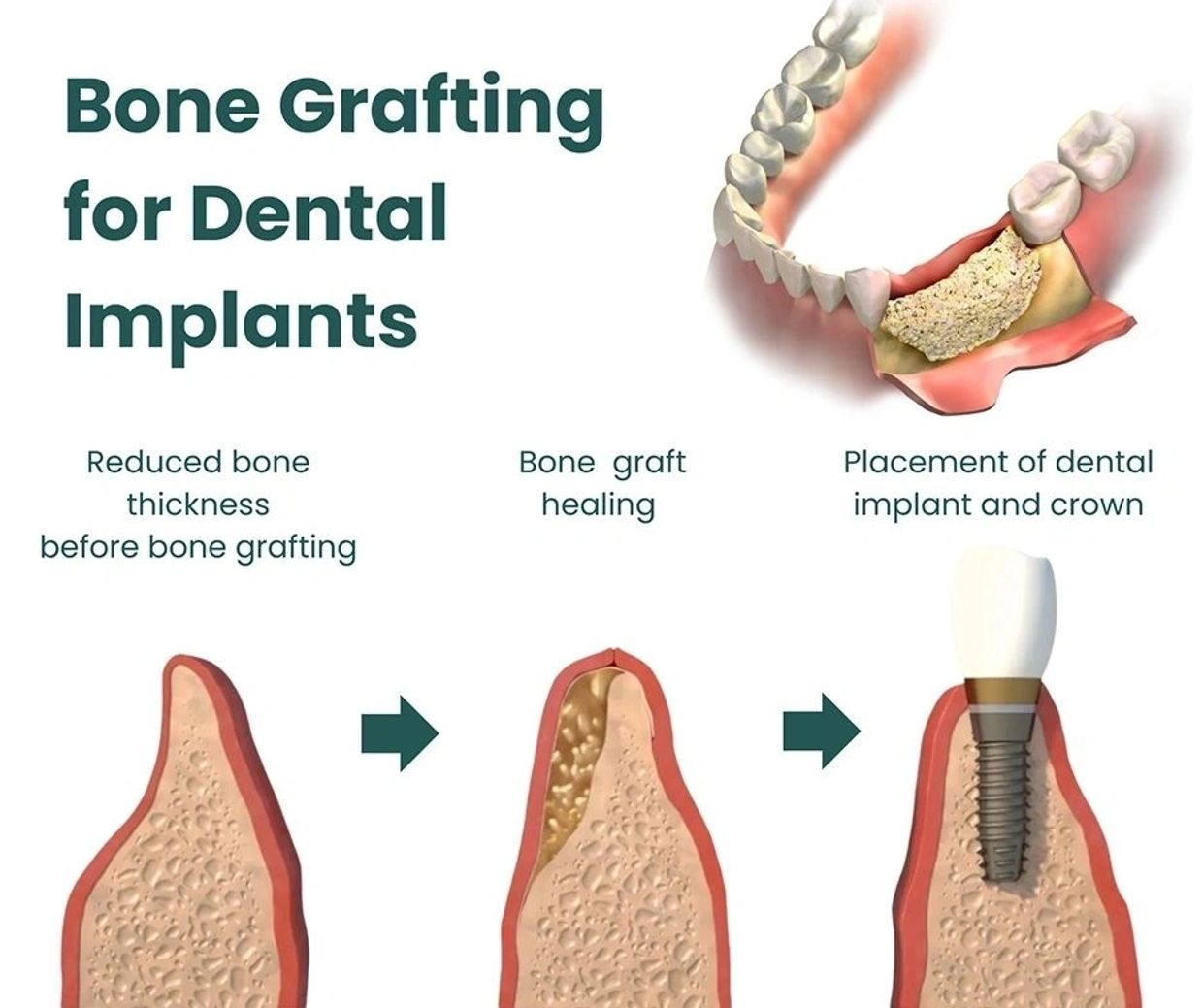 Dental bone grafting procedure infographic.