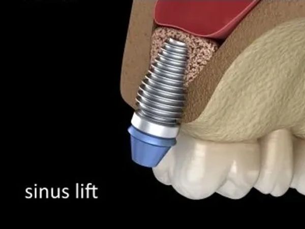 Illustration of a dental implant with sinus lift procedure.