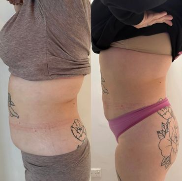 RESULTS OF FAT CAVITATION, RADIO FREQUENCY AND LASER LIPO AFTER TWO SESSIONS