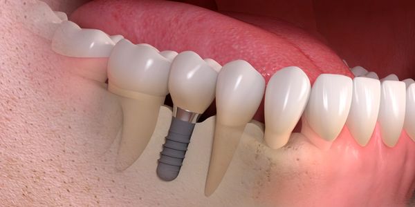 Dental Implant
Dental Implants
Implantology
Oral Surgery
Dentures
All on 4
Removable Dentures
