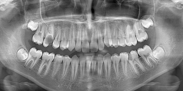 Panoramic dental X-ray showing adult teeth with wisdom teeth developing.