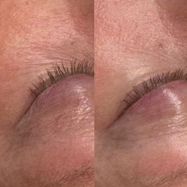 Before and after image showing wrinkle reduction after a facial with oxygen infusion.