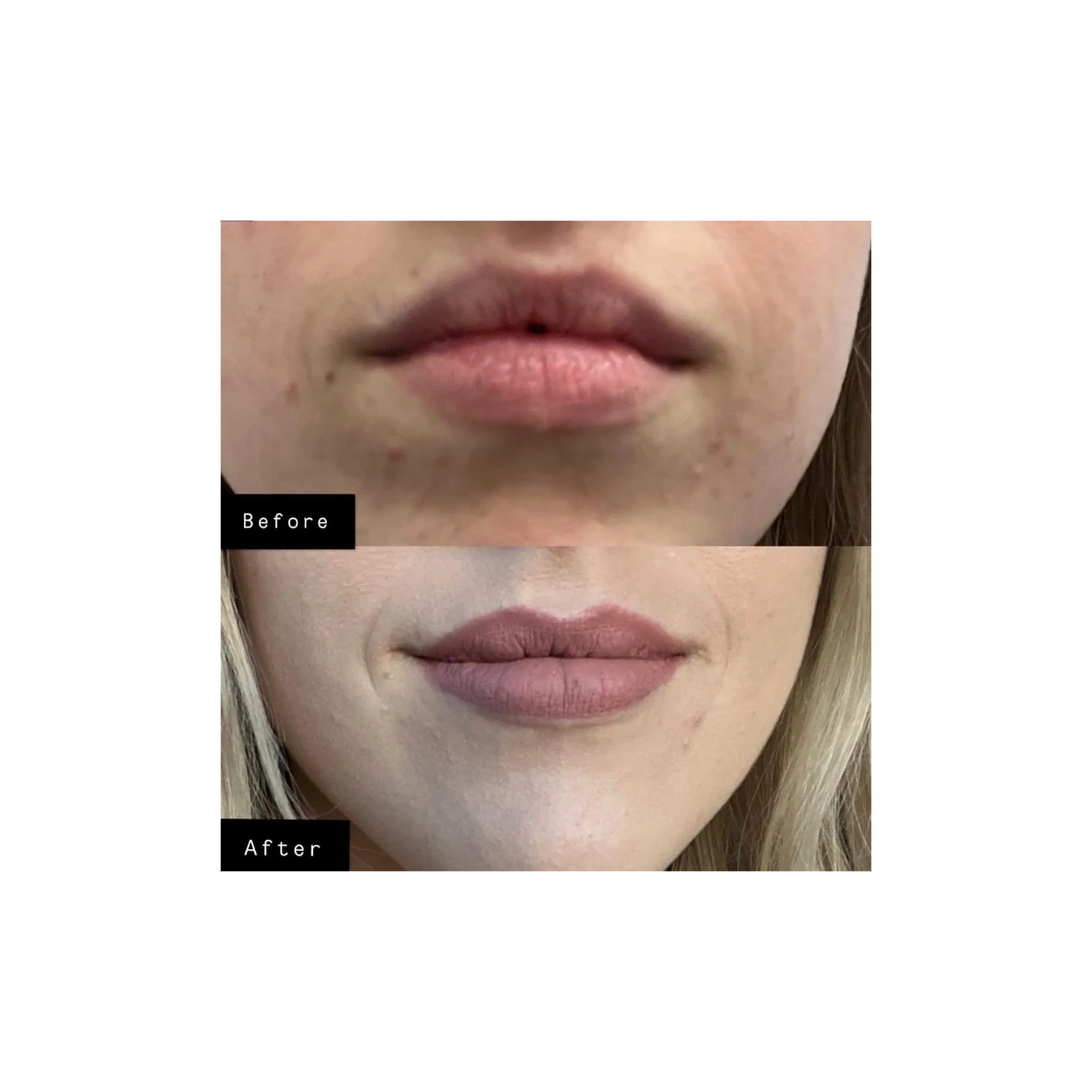 Before and after Lip filler