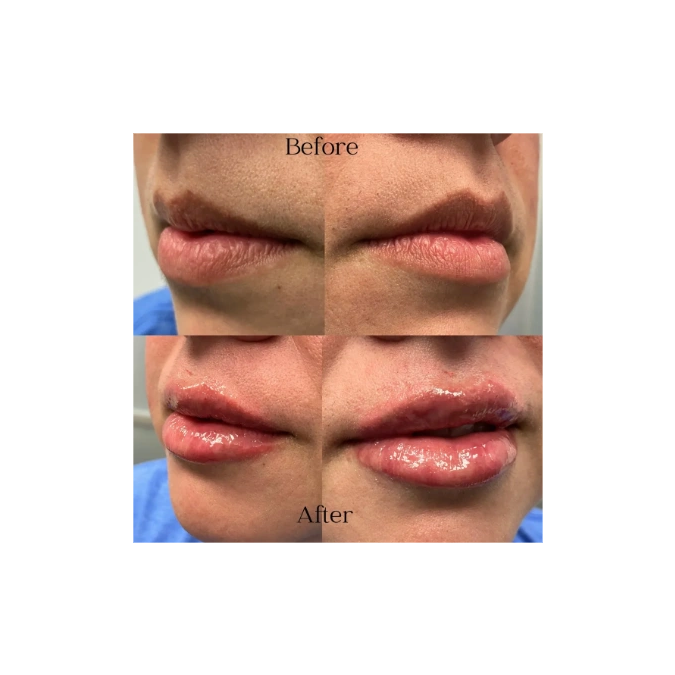 before and after lip filler