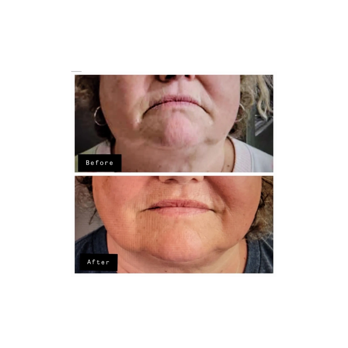 Botox can improve marionette lines that extend from the corners of your mouth to your chin. 
