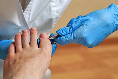 Ingrown toenail, pain, redness, swelling, avulsion, matrixectomy 