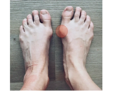 Bunion, bunion pain, big toe joint pain, inflammation