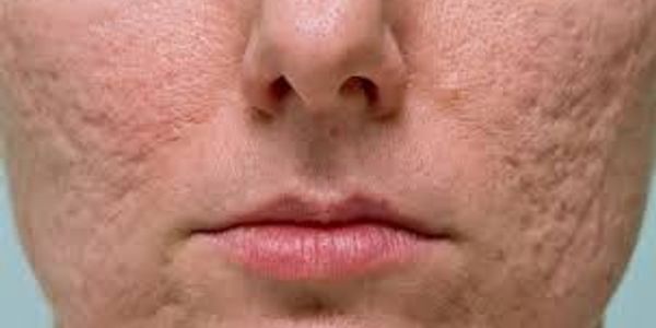 Close-up of a face with acne scars and textured skin.