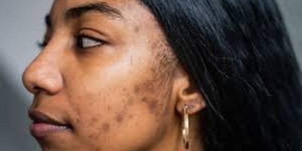 Close-up of a young woman with acne scars on her cheek.