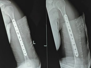 FRACTURE TREATMENT
