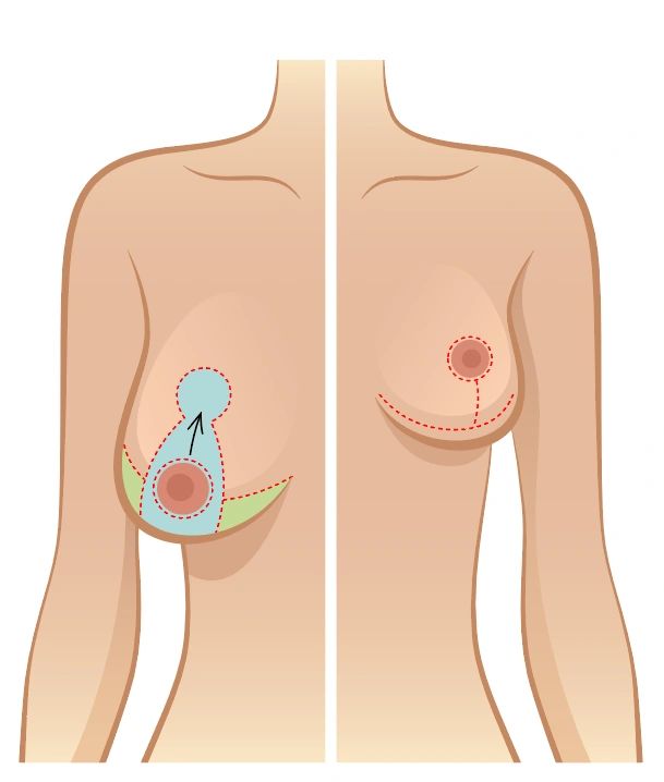 Skin Surgery Center of Virginia - Should You Get Breast Reduction