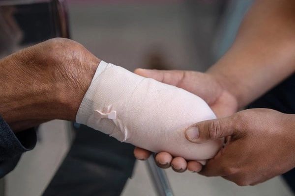 Amputation Compensation Claims