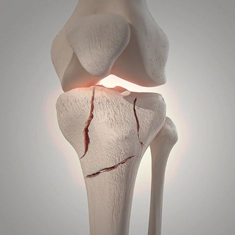 Broken Bone Injury Compensation Claims