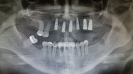 Jupiter Dental Implant
Edward broggi DMD
561-704-5748
561-702-003