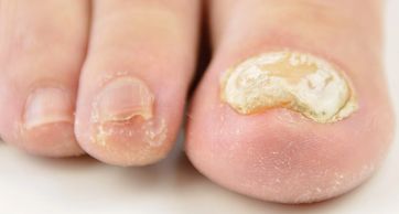 Ingrown or thickened nails, Onychauxis, Onychocryptosis