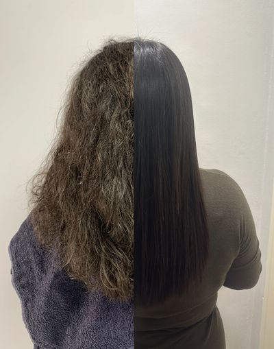 before and after nonoplasty