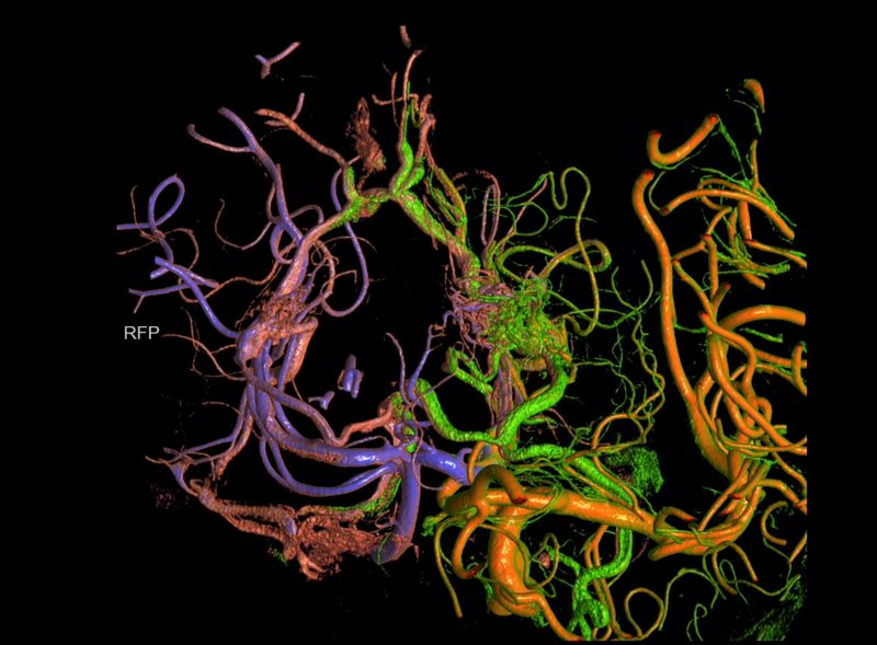 Neurovascular imaging