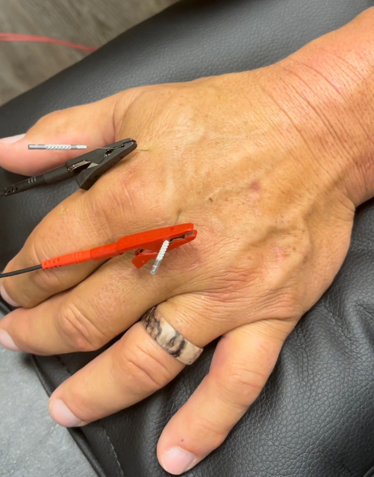 COMBINING TECHNIQUES: GRASTON AND FUNCTIONAL DRY NEEDLING +E-STIM