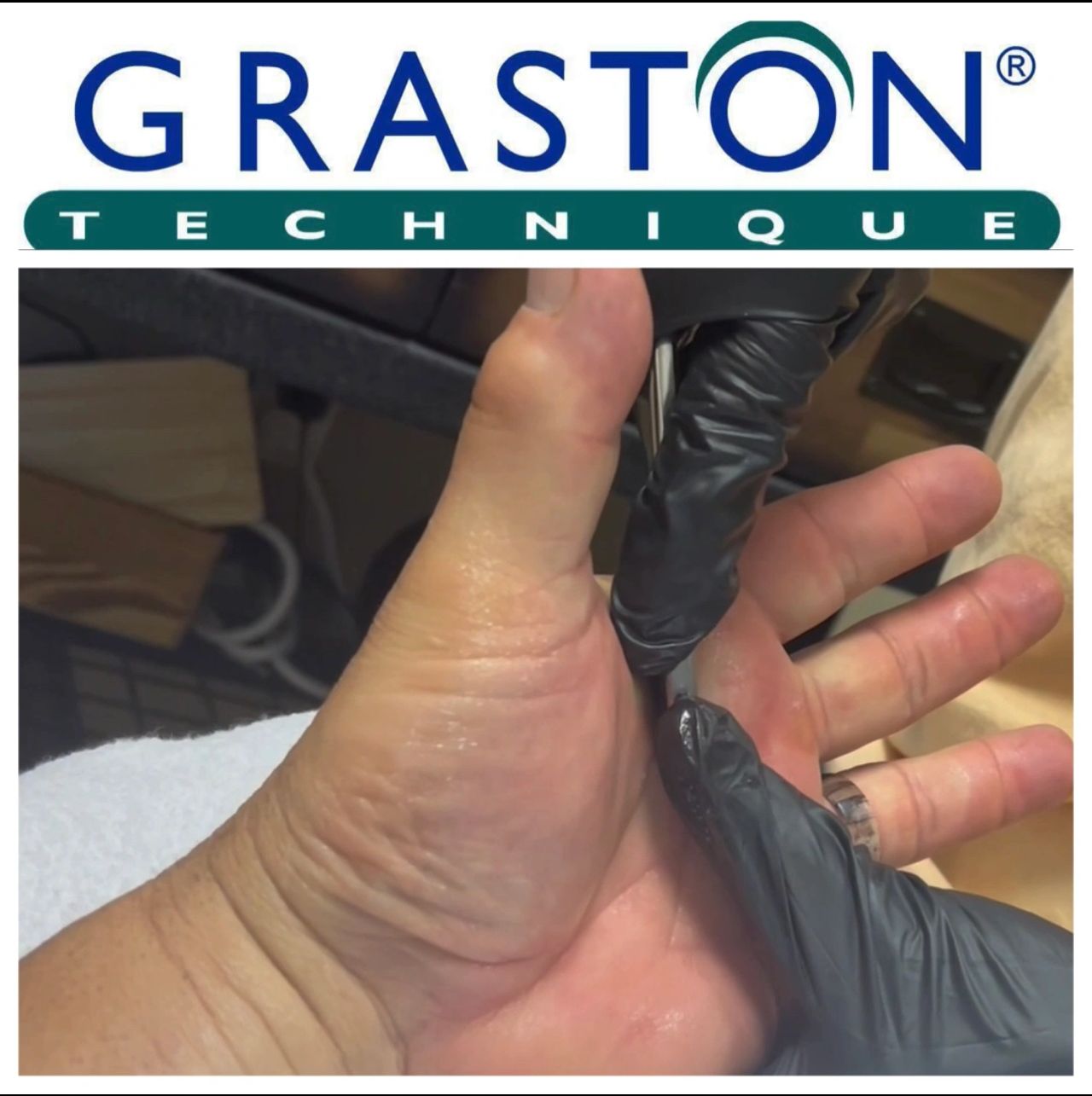 COMBINING TECHNIQUES: GRASTON AND FUNCTIONAL DRY NEEDLING +E-STIM