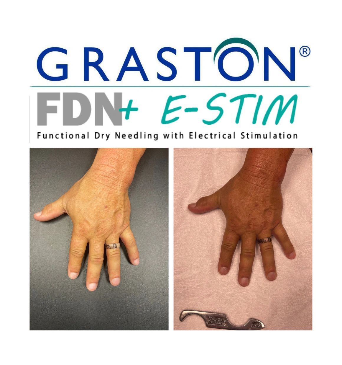 COMBINING TECHNIQUES: GRASTON AND FUNCTIONAL DRY NEEDLING +E-STIM