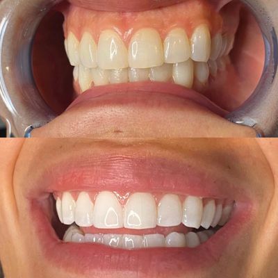 Before and after dental veneers showing a brighter, more aligned smile.