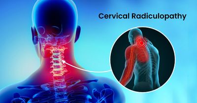 Pinched Nerve (Cervical Radiculopathy)