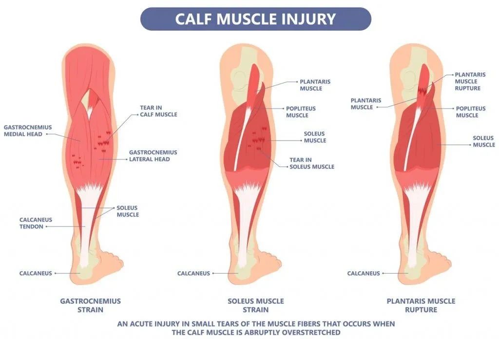 All About Calf Strains - Canberra Physiotherapy clinic - TM Physio