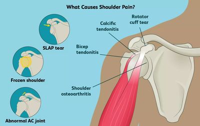 Shoulder Pain - My Physio & Rehab