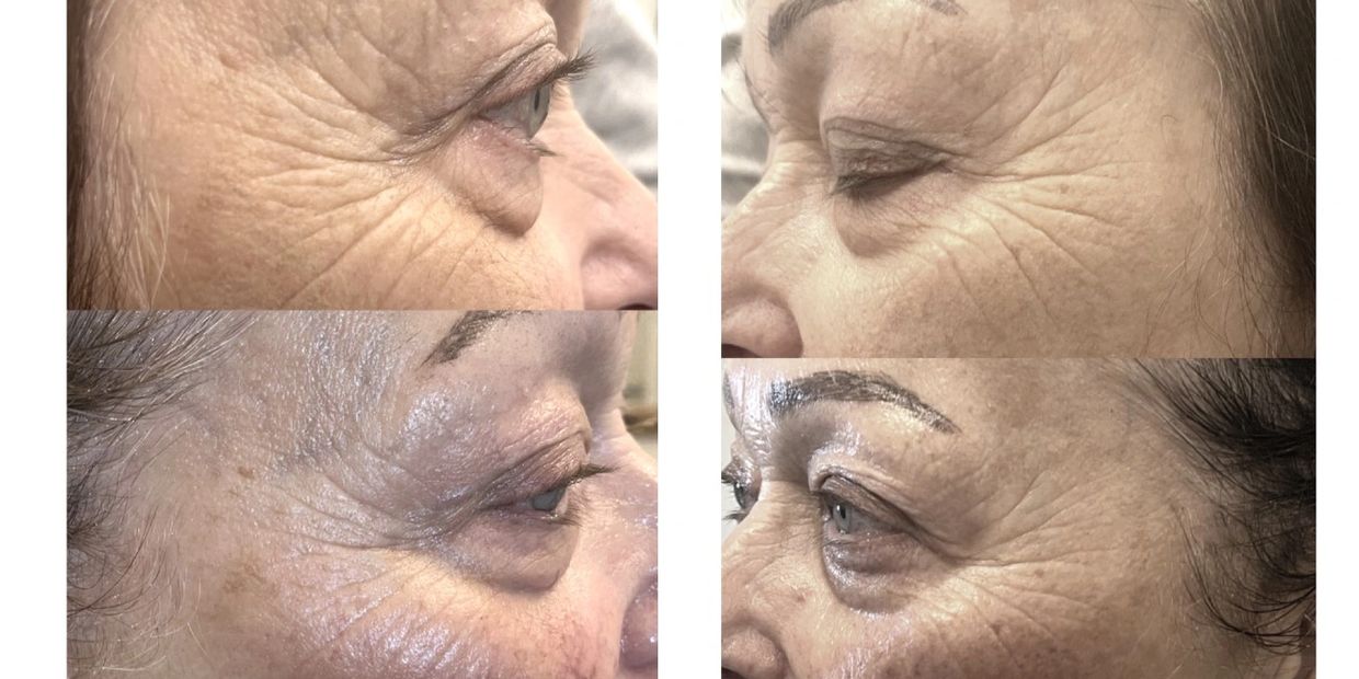 74 year old client. 1 session.  3-6 will be needed for longer term result. 