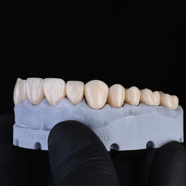 Dental prosthetic model showcasing a set of artificial teeth held by a gloved hand.