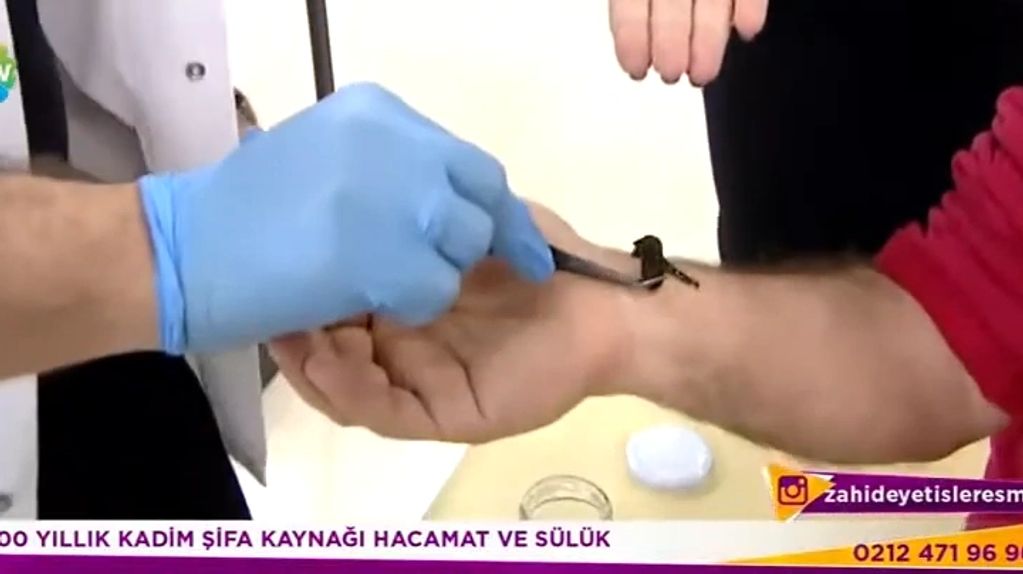 sülük tedavisi,ağrı,kireçlenme