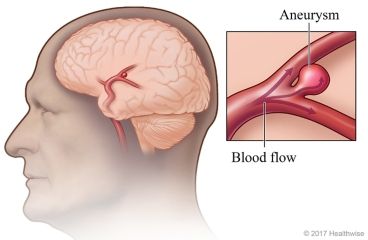 Brain Aneurysm