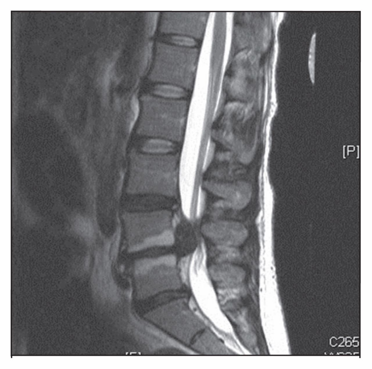 Cauda Equina Syndrome from Lumbar Disc Herniation