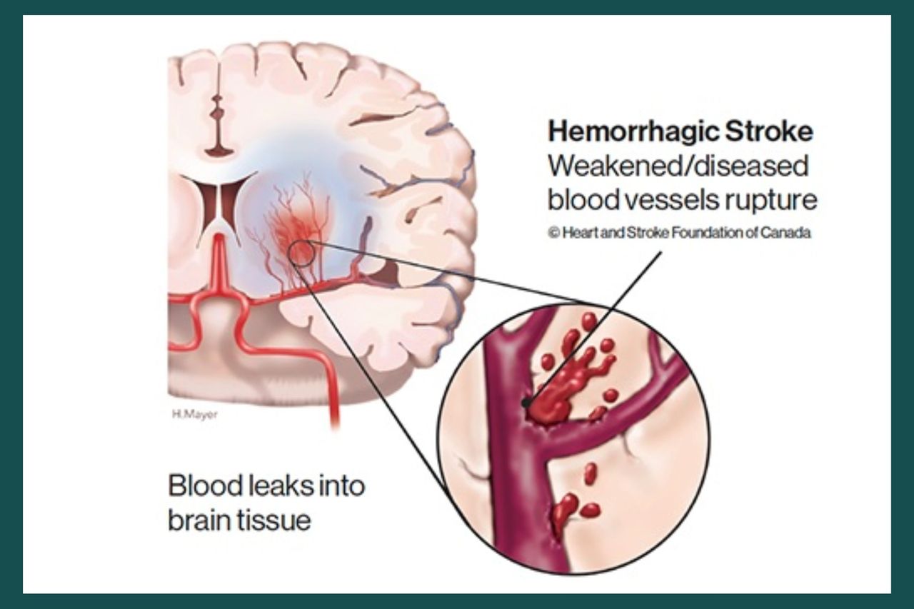 Hemorrhagic stroke