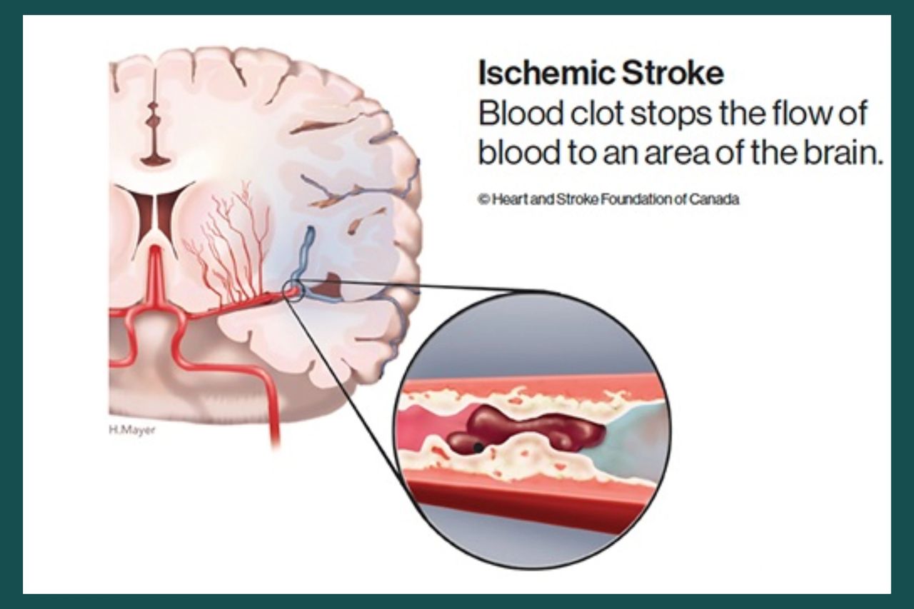 Ischemic stroke