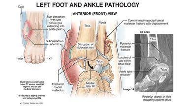 Image depicting left foot and ankle pathology.