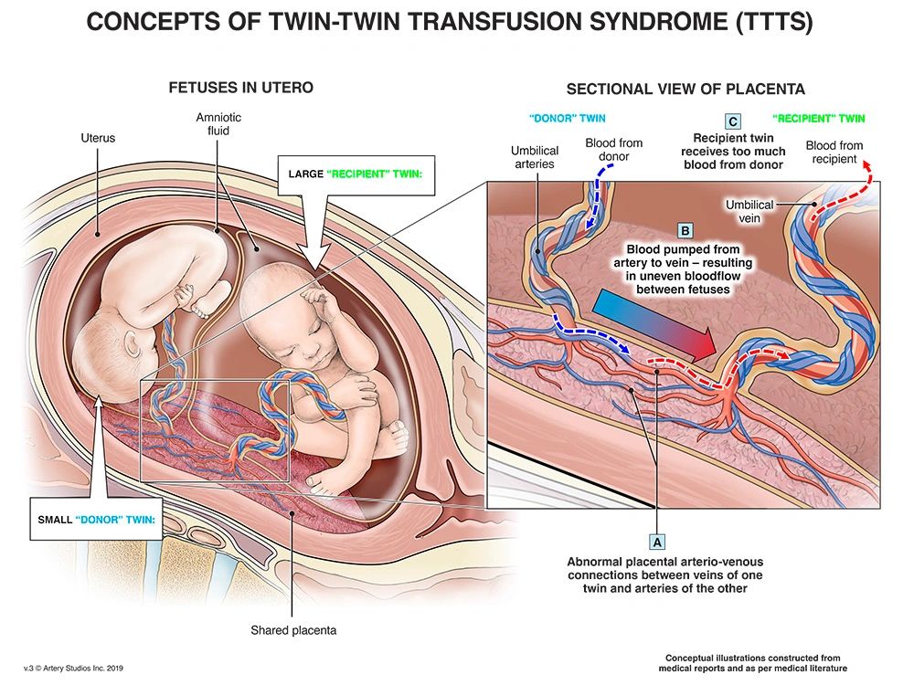 Concepts of Twin to Twin Transfusion Syndrome (TTTS)