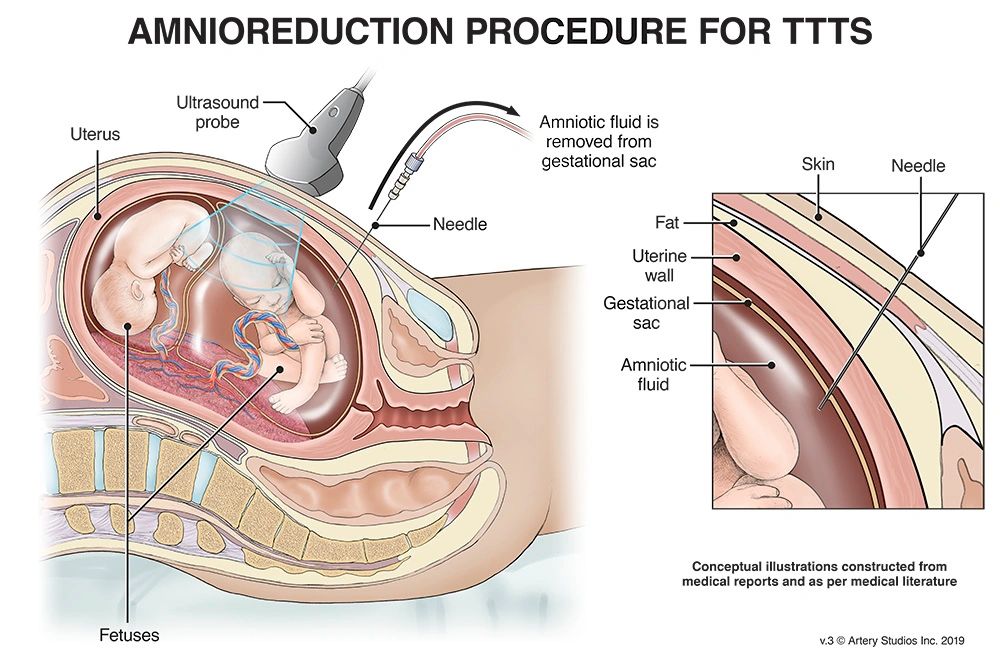 Amnioreduction Procedure for TTTS